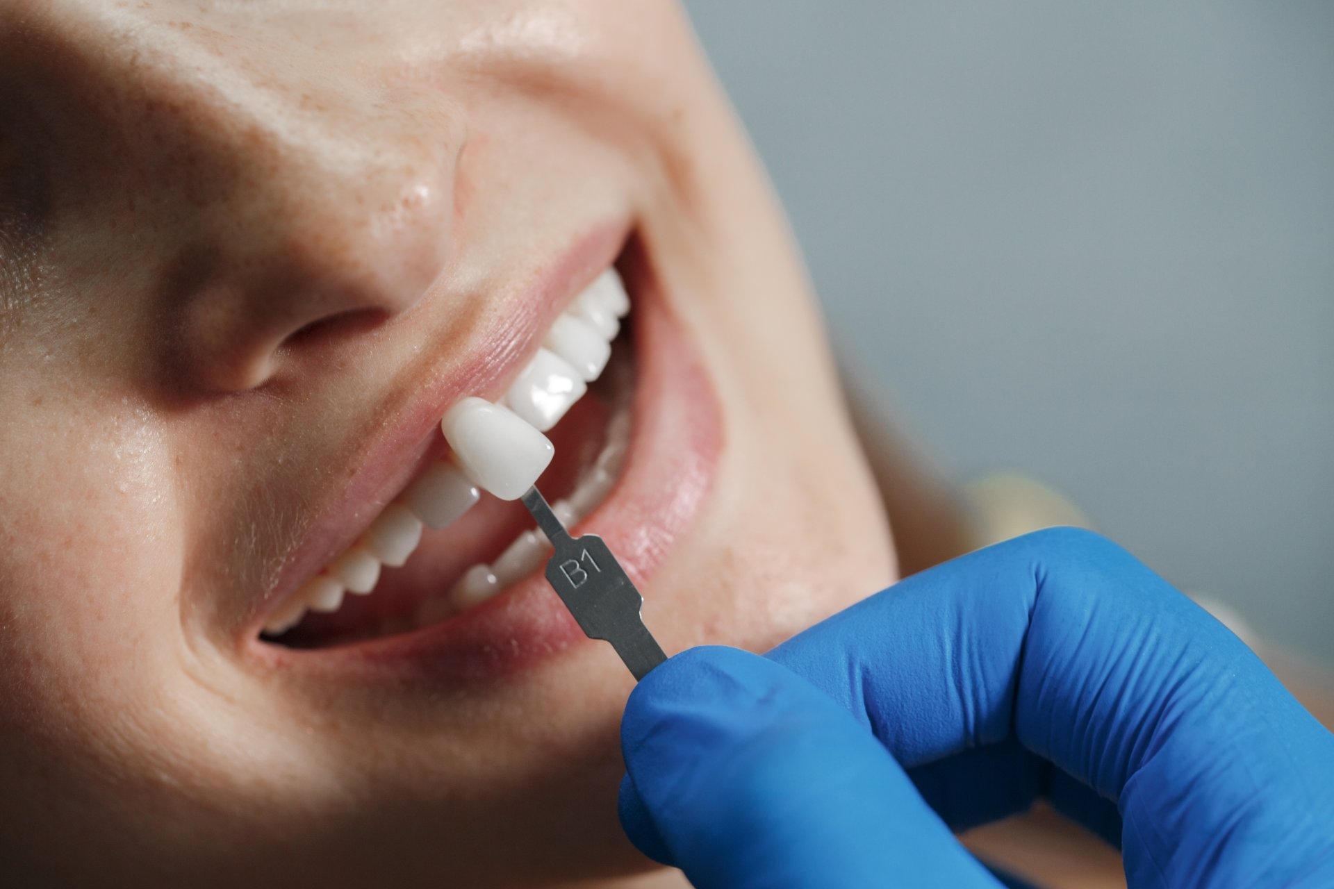 Implant dentar București – soluție modernă pentru dinți lipsă