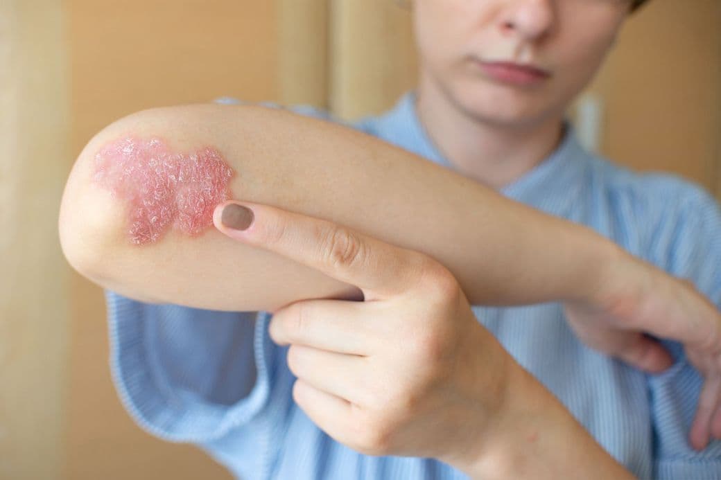 Diagnosticare și tratament dermatită atopică