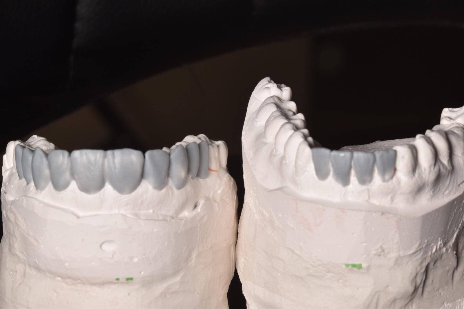 modelarea in ceara - wax up