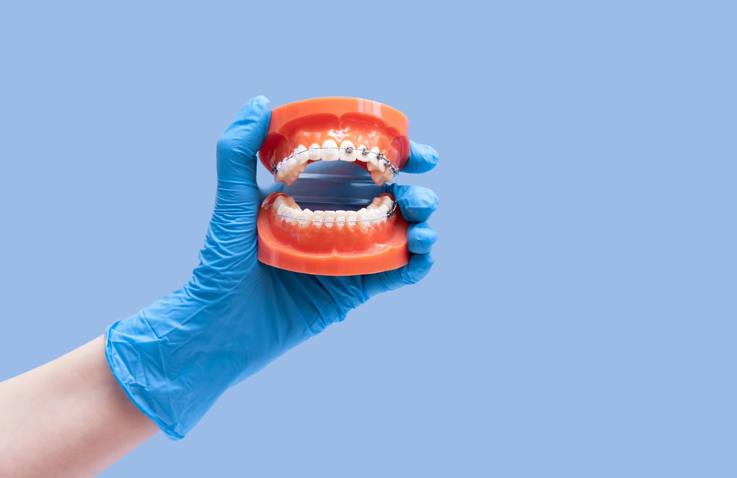 aparat dentar metalic sau autoligaturant