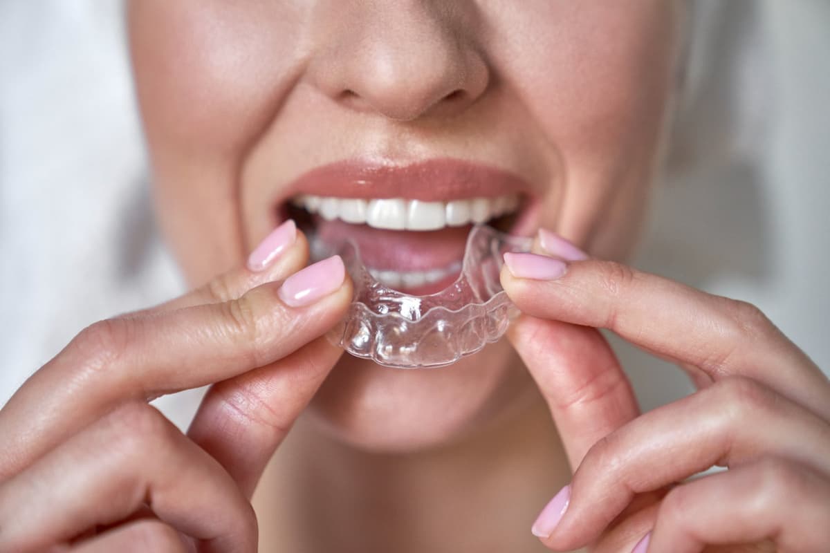 Avantaje ale tratamentului cu gutiere Spark