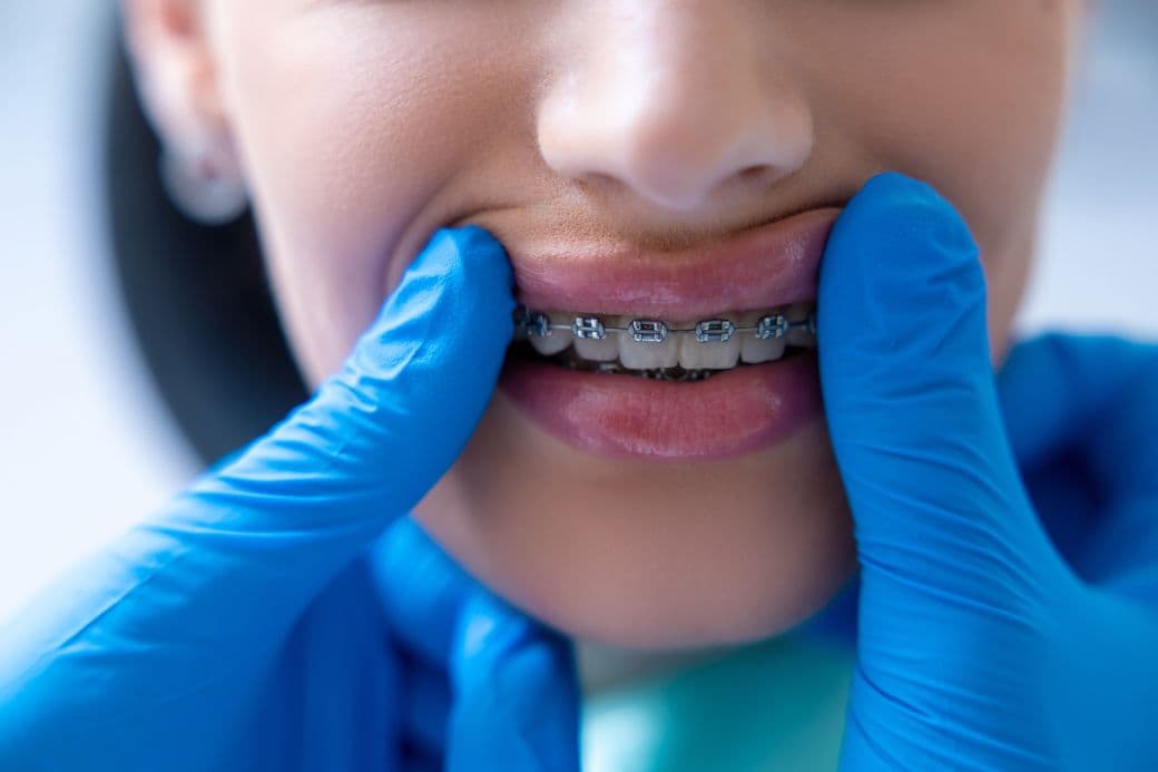 Ce sunt aparatele dentare?